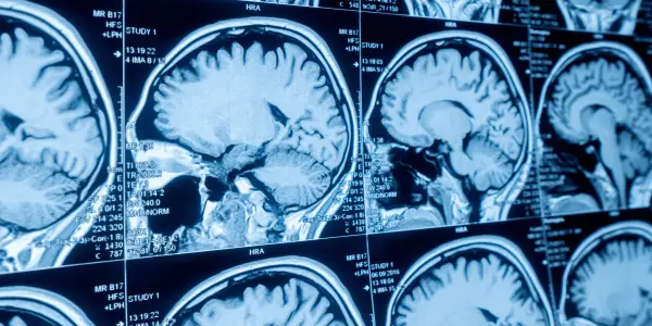 Experimental Brain Stimulation Offers Hope to Patient After Decades of Depression