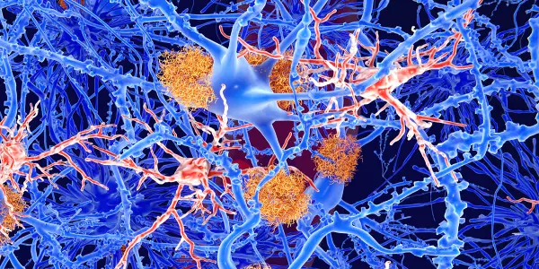 New Study Challenges Effectiveness of Lecanemab in Alzheimer's Treatment