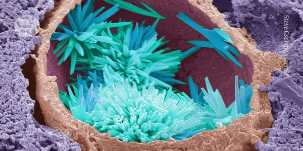 Gene Editing and Cholesterol: A Potential Breakthrough in Heart Disease Prevention