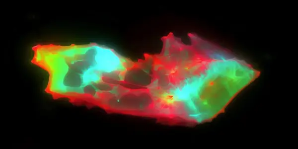Breakthrough Study Reveals Microscopic Abnormalities in Blood of Long COVID Survivors