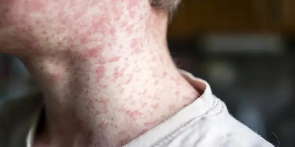 Measles Outbreak in South Carolina Leads to Quarantine of Over 150 Unvaccinated Children