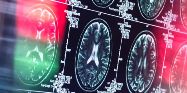 Reevaluating Alzheimer's: New Insights Suggest Immune System Role
