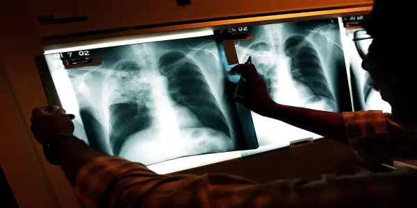 Confirmed Tuberculosis Case Emerges at Aegis Living Facility in Washington