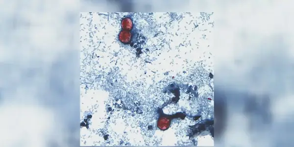 Michigan Sees Surge in Cyclosporiasis Cases, Approaching 700 Infections